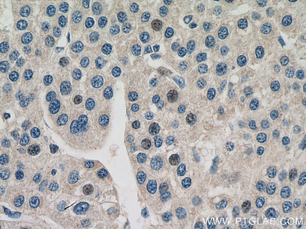 IHC staining of human liver cancer using 66706-1-Ig
