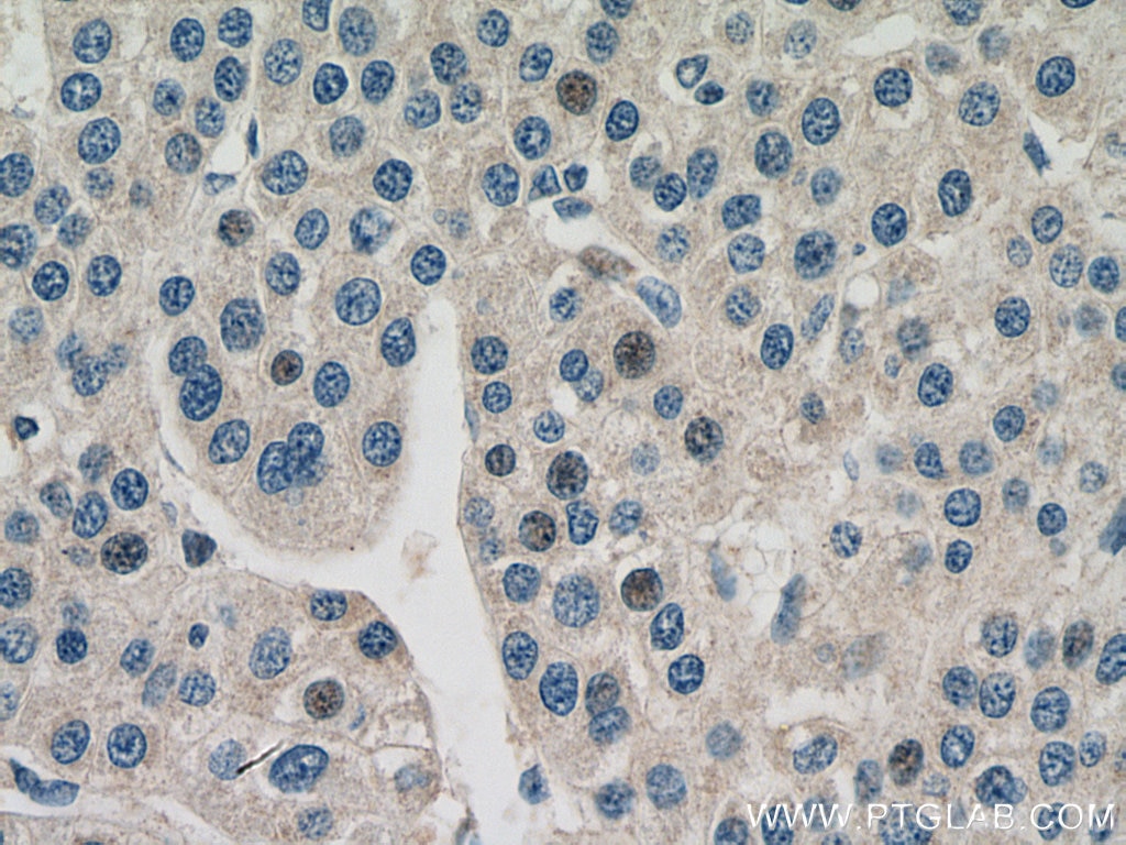 Immunohistochemistry (IHC) staining of human liver cancer tissue using MTAP Monoclonal antibody (66706-1-Ig)