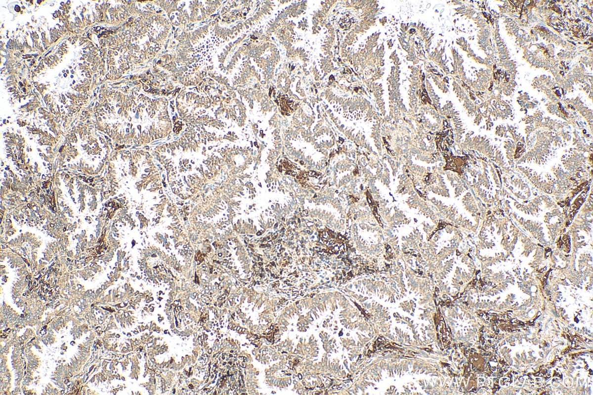 Immunohistochemistry (IHC) staining of human lung cancer tissue using MTBP Polyclonal antibody (28356-1-AP)
