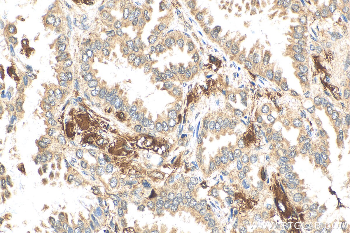 Immunohistochemistry (IHC) staining of human lung cancer tissue using MTBP Polyclonal antibody (28356-1-AP)