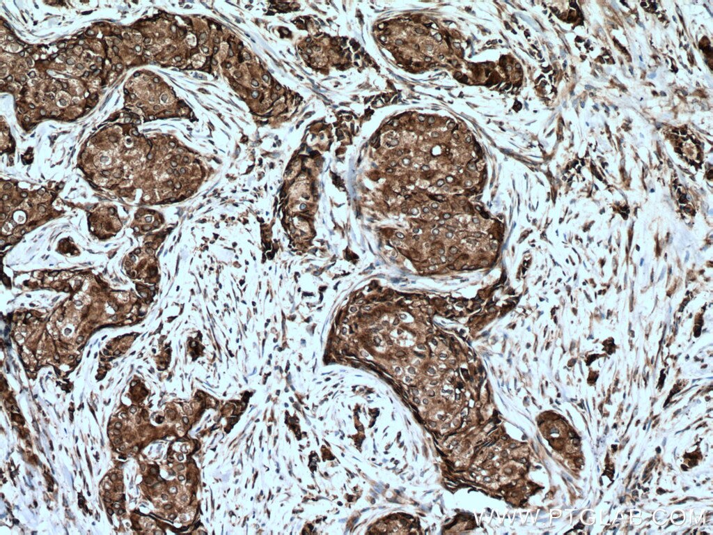 Immunohistochemistry (IHC) staining of human breast cancer tissue using AEG-1/MTDH-Specific Polyclonal antibody (13860-1-AP)