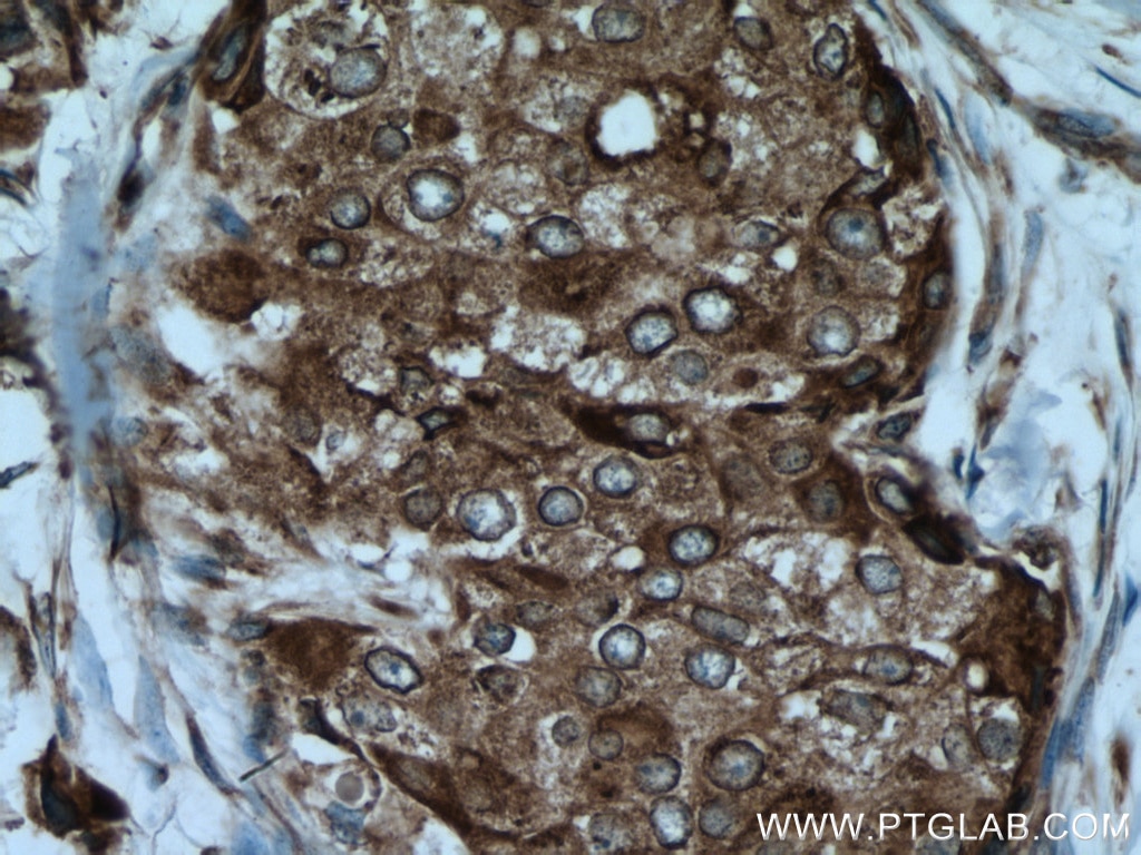 Immunohistochemistry (IHC) staining of human breast cancer tissue using AEG-1/MTDH-Specific Polyclonal antibody (13860-1-AP)