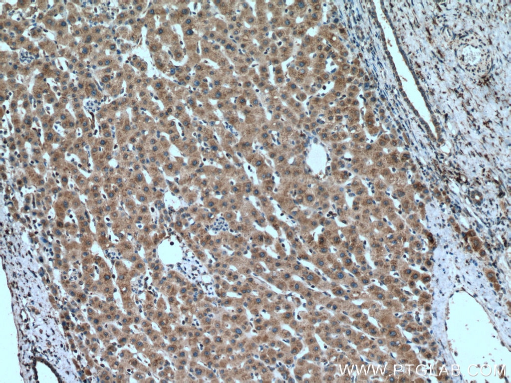 Immunohistochemistry (IHC) staining of human liver cancer tissue using AEG-1/MTDH-Specific Polyclonal antibody (13860-1-AP)