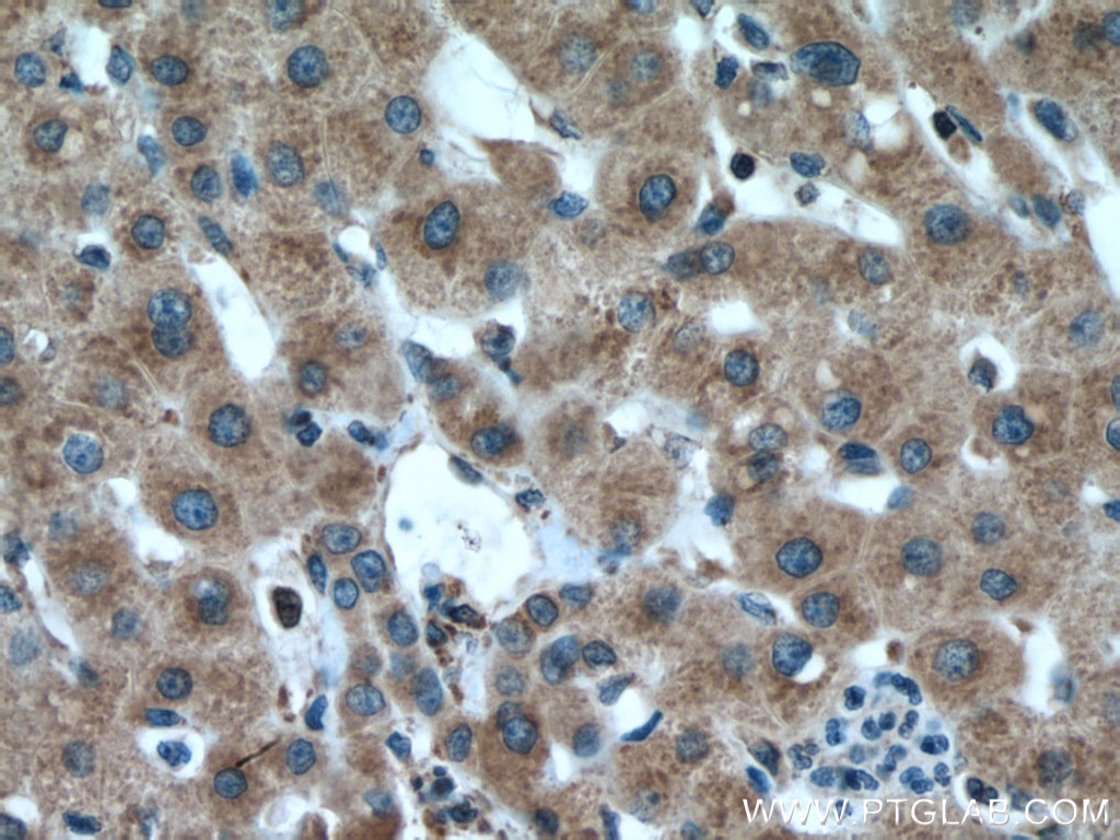 Immunohistochemistry (IHC) staining of human liver cancer tissue using AEG-1/MTDH-Specific Polyclonal antibody (13860-1-AP)