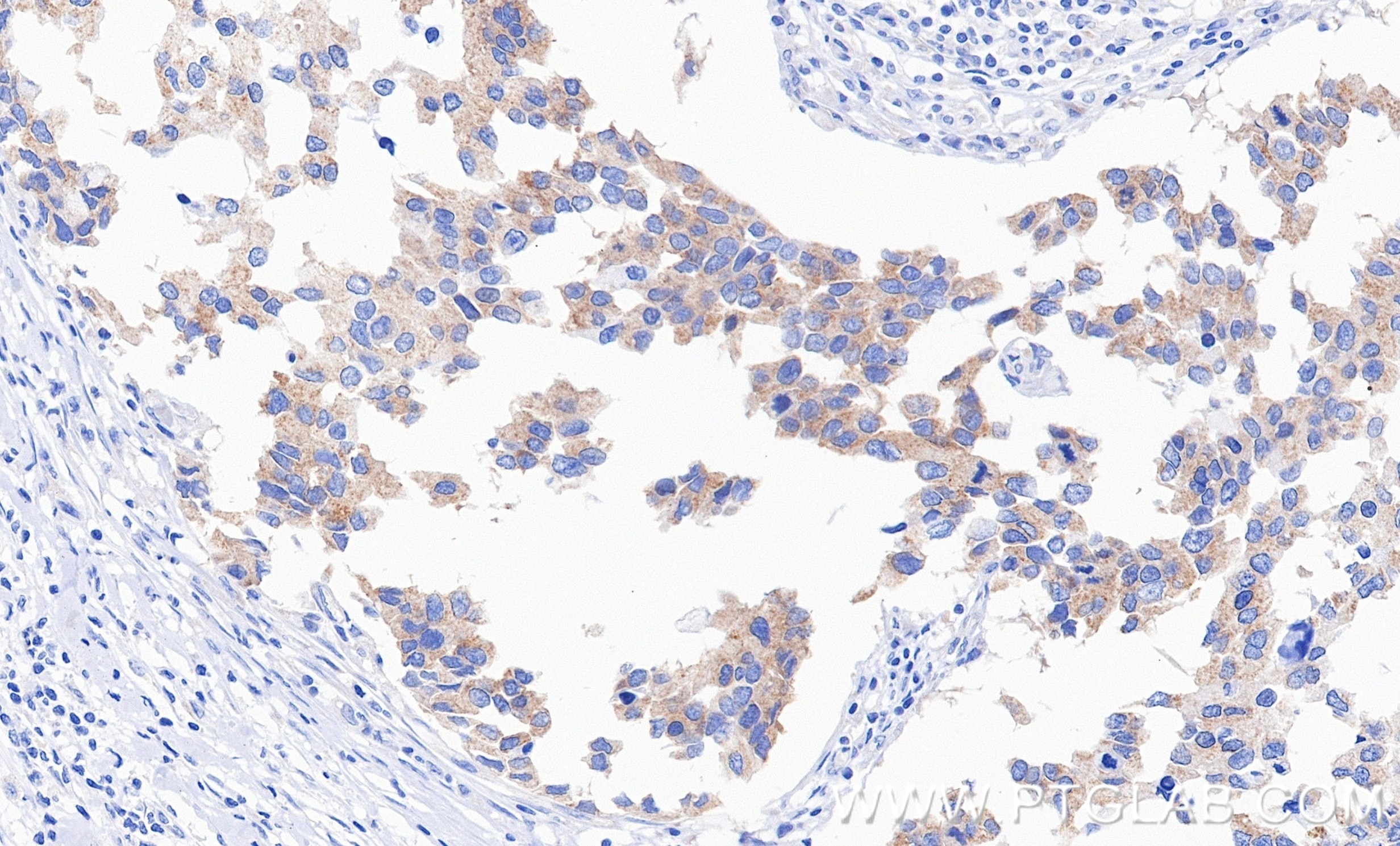 Immunohistochemistry (IHC) staining of human breast cancer tissue using MTFR1 Recombinant monoclonal antibody (87130-1-RR)
