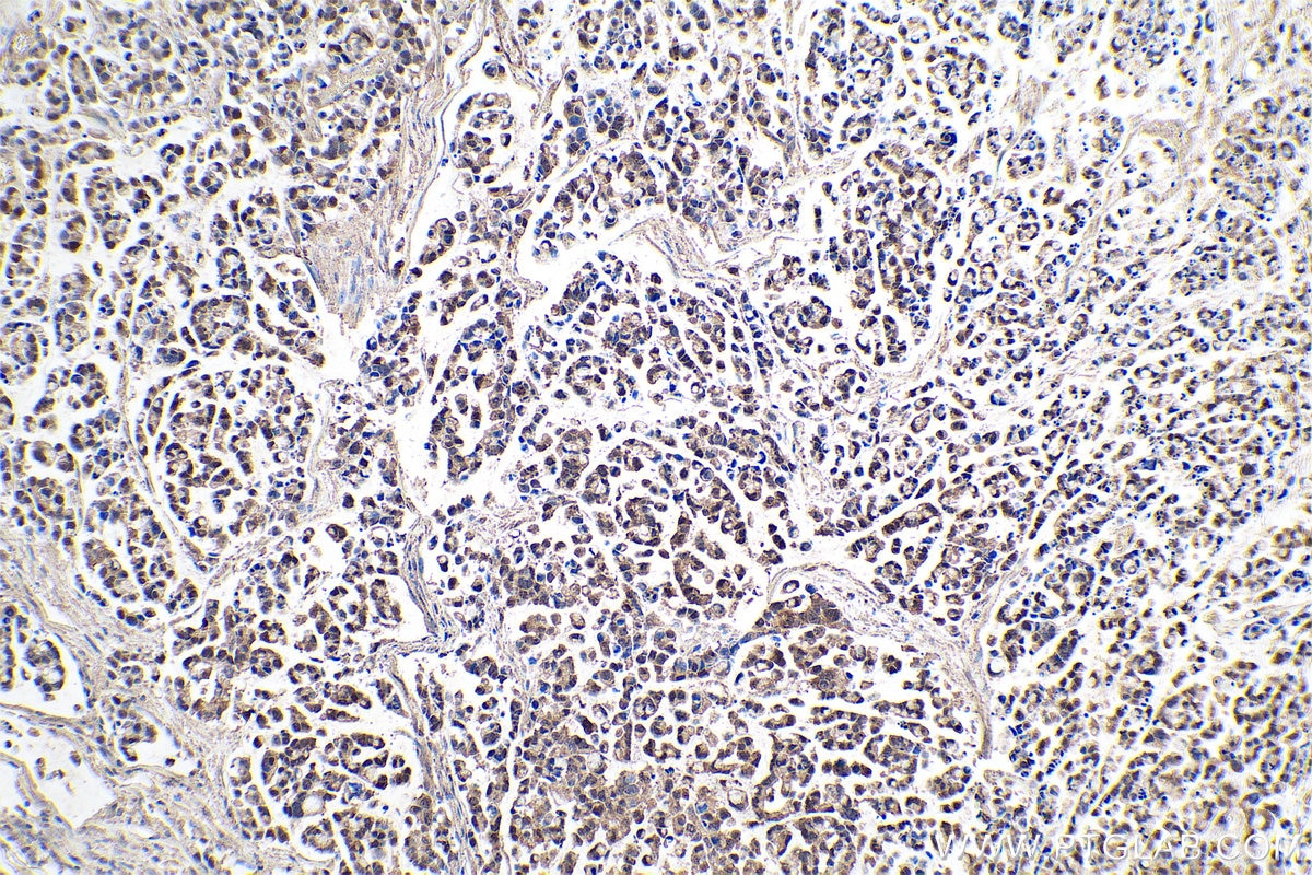 Immunohistochemistry (IHC) staining of human colon cancer tissue using MTH1 Monoclonal antibody (67443-1-Ig)