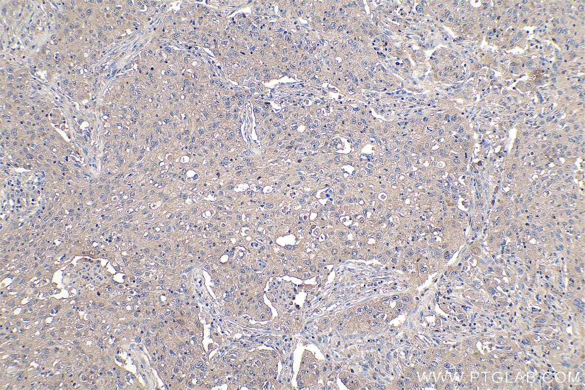 Immunohistochemistry (IHC) staining of human lung cancer tissue using MTH1 Monoclonal antibody (67443-1-Ig)