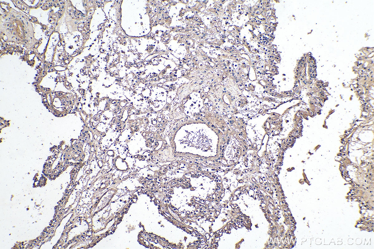 Immunohistochemistry (IHC) staining of human renal cell carcinoma tissue using MTH1 Monoclonal antibody (67443-1-Ig)