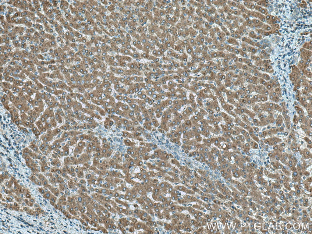 IHC staining of human liver cancer using 10794-1-AP
