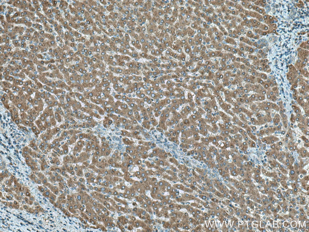 Immunohistochemistry (IHC) staining of human liver cancer tissue using MTHFD1 Polyclonal antibody (10794-1-AP)