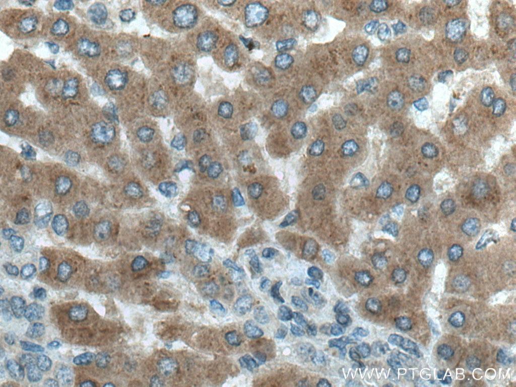 Immunohistochemistry (IHC) staining of human liver cancer tissue using MTHFD1 Polyclonal antibody (10794-1-AP)