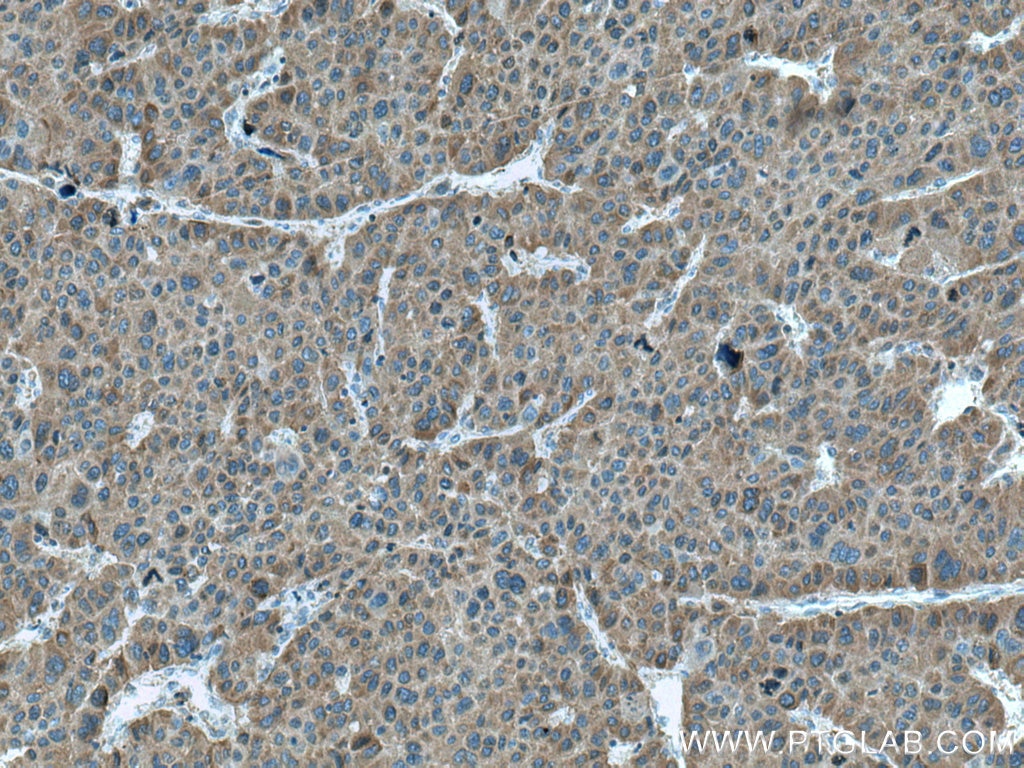 Immunohistochemistry (IHC) staining of human liver cancer tissue using MTHFD1 Polyclonal antibody (10794-1-AP)