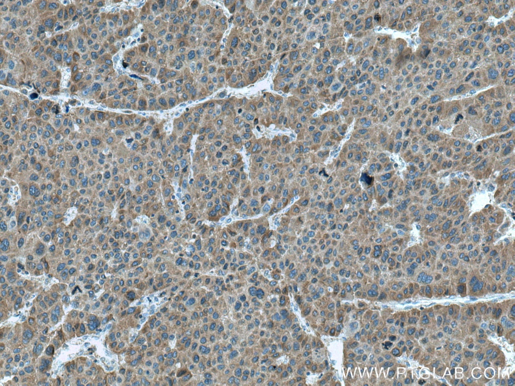 IHC staining of human liver cancer using 10794-1-AP