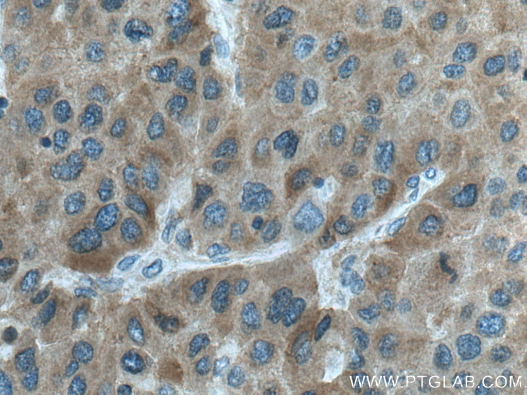 Immunohistochemistry (IHC) staining of human liver cancer tissue using MTHFD1 Polyclonal antibody (10794-1-AP)