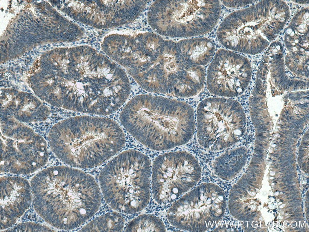 Immunohistochemistry (IHC) staining of human colon cancer tissue using MTHFD1 Polyclonal antibody (10794-1-AP)