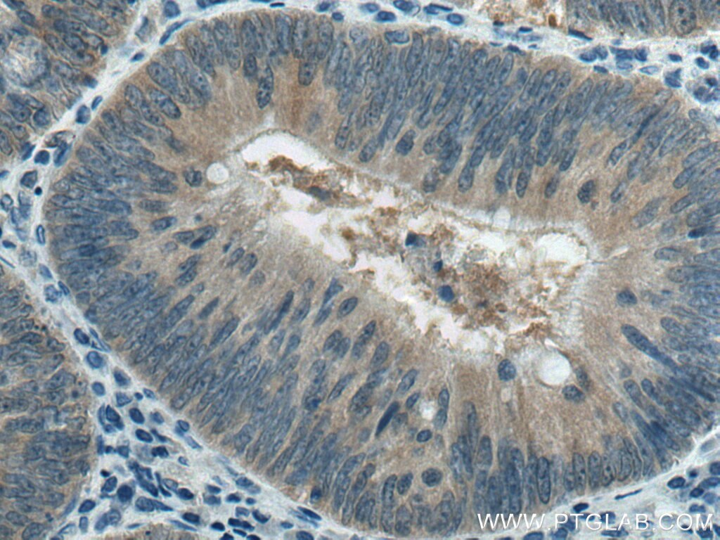 IHC staining of human colon cancer using 10794-1-AP