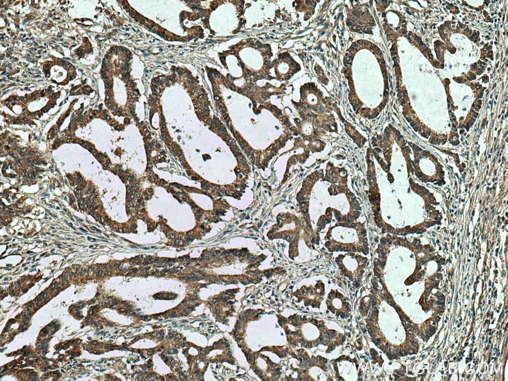 Immunohistochemistry (IHC) staining of human colon cancer tissue using MTHFD1 Monoclonal antibody (67670-1-Ig)