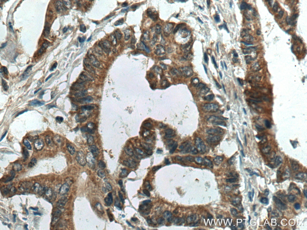 IHC staining of human colon cancer using 67670-1-Ig