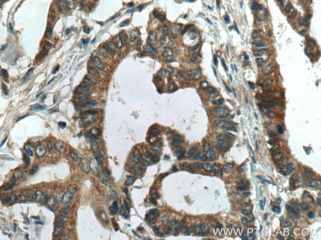 Immunohistochemistry (IHC) staining of human colon cancer tissue using MTHFD1 Monoclonal antibody (67670-1-Ig)