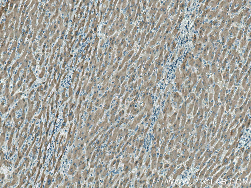 Immunohistochemistry (IHC) staining of human liver cancer tissue using MTHFD1 Monoclonal antibody (67670-1-Ig)