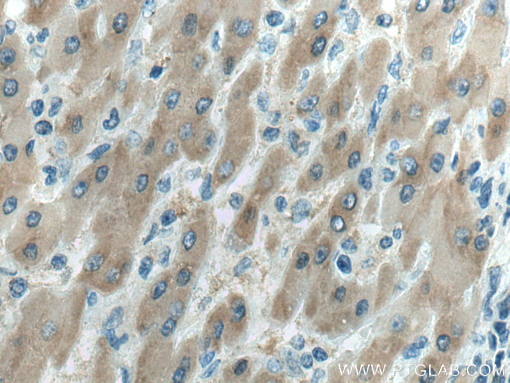 Immunohistochemistry (IHC) staining of human liver cancer tissue using MTHFD1 Monoclonal antibody (67670-1-Ig)