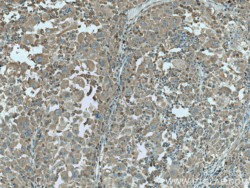 Immunohistochemistry (IHC) staining of human liver cancer tissue using MTHFD1 Monoclonal antibody (67670-1-Ig)