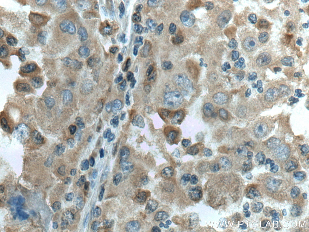 Immunohistochemistry (IHC) staining of human liver cancer tissue using MTHFD1 Monoclonal antibody (67670-1-Ig)