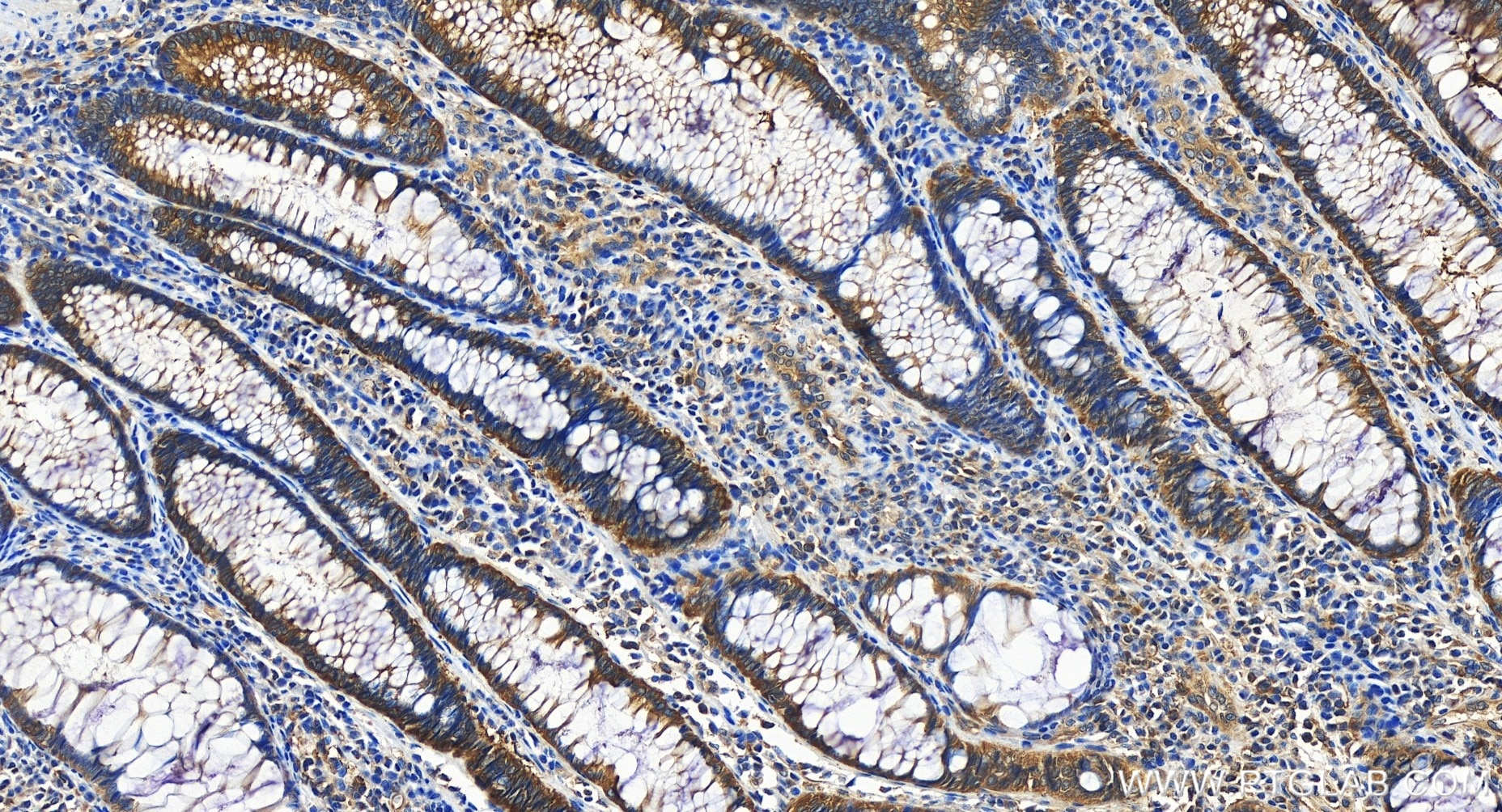 Immunohistochemistry (IHC) staining of human colon cancer tissue using MTHFD1 Recombinant antibody (84884-5-RR)