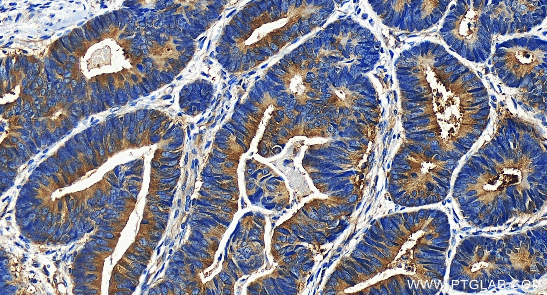 Immunohistochemistry (IHC) staining of human colon cancer tissue using MTHFD1 Recombinant antibody (84884-5-RR)