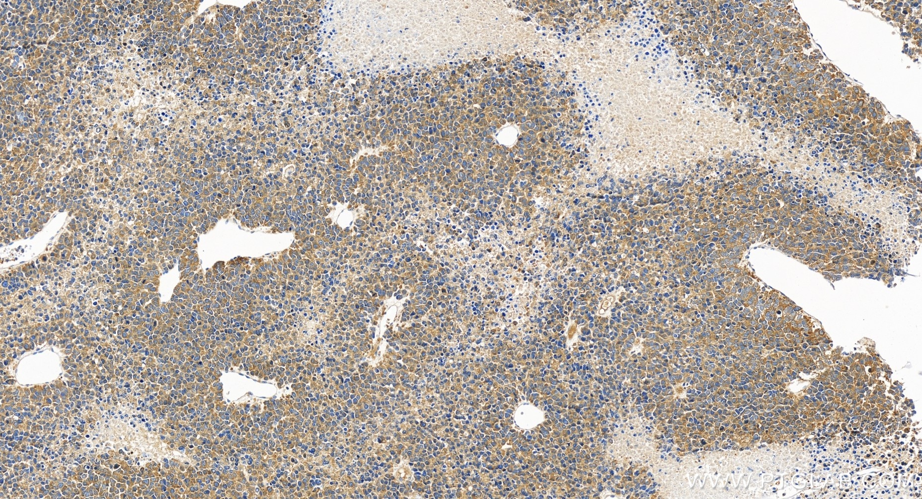 Immunohistochemistry (IHC) staining of human liver cancer tissue using MTHFD1 Recombinant antibody (84884-5-RR)