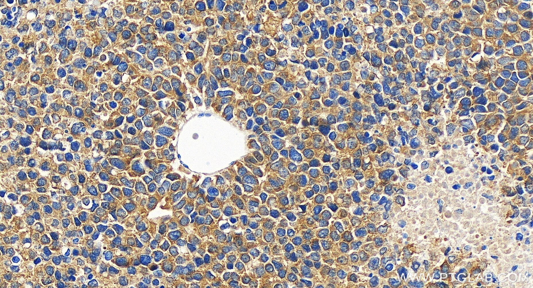 Immunohistochemistry (IHC) staining of human liver cancer tissue using MTHFD1 Recombinant antibody (84884-5-RR)