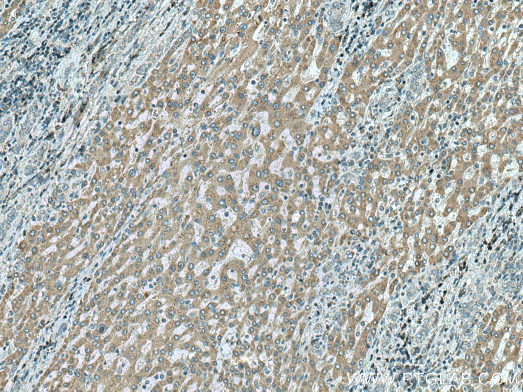 Immunohistochemistry (IHC) staining of human liver cancer tissue using MTHFD1L Polyclonal antibody (16113-1-AP)