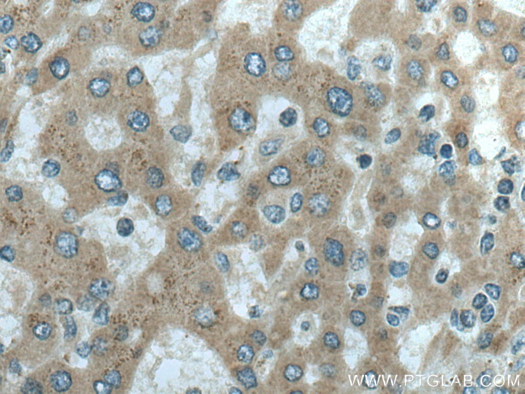 Immunohistochemistry (IHC) staining of human liver cancer tissue using MTHFD1L Polyclonal antibody (16113-1-AP)