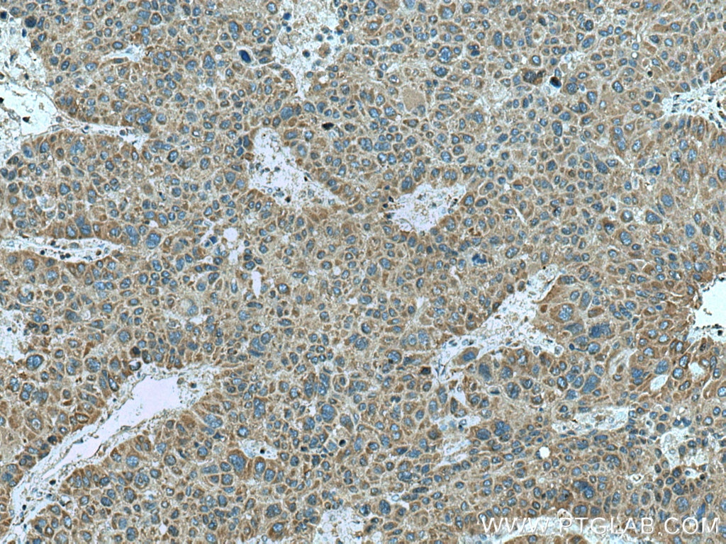 IHC staining of human liver cancer using 16113-1-AP