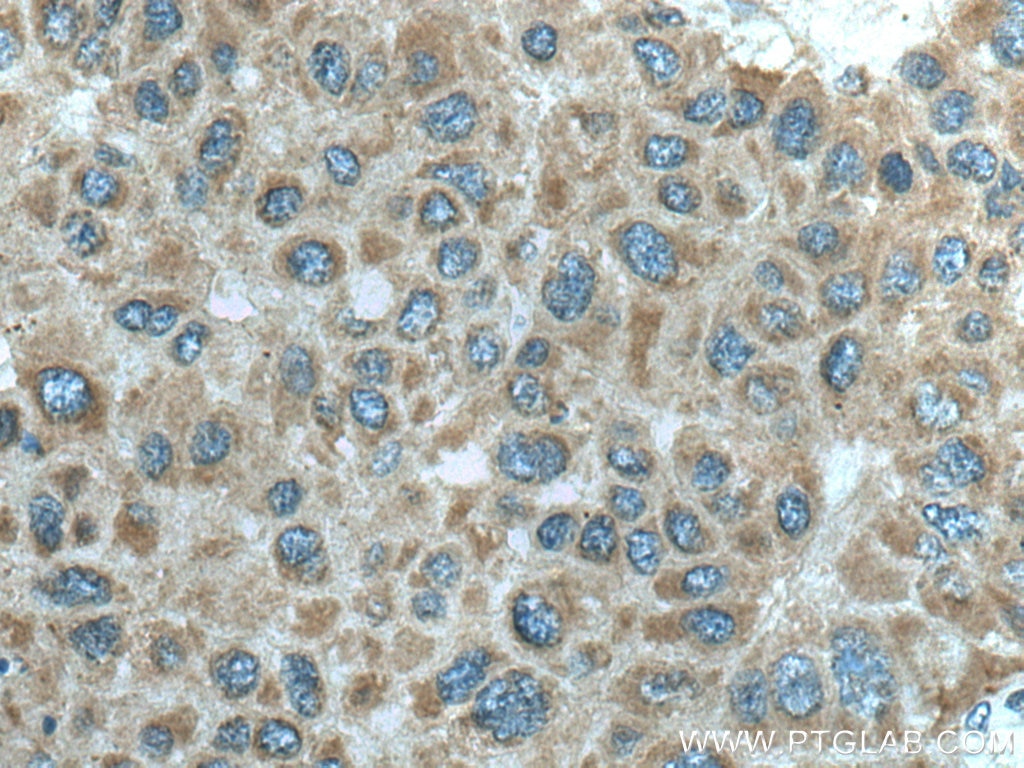 Immunohistochemistry (IHC) staining of human liver cancer tissue using MTHFD1L Polyclonal antibody (16113-1-AP)