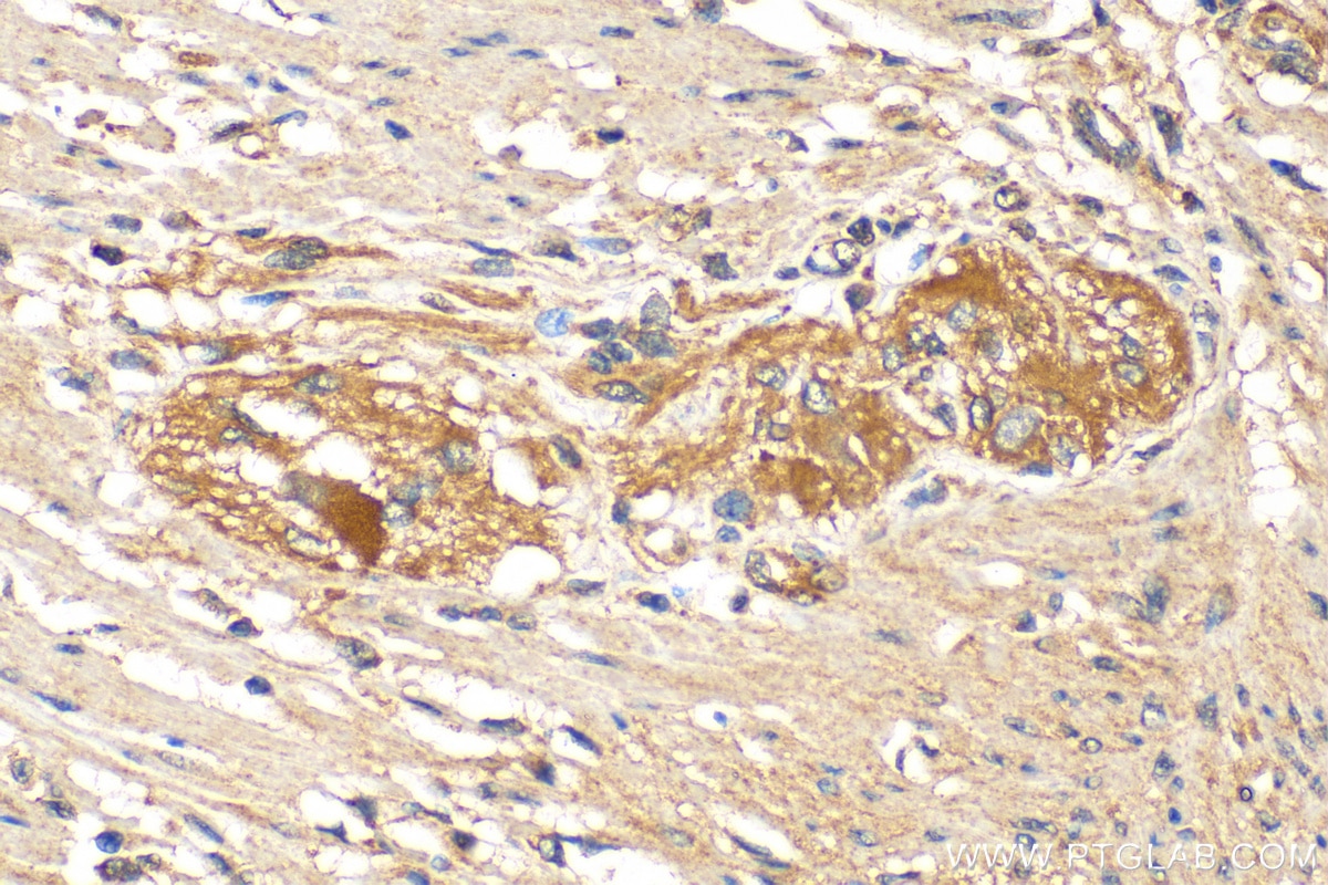 Immunohistochemistry (IHC) staining of human colon cancer tissue using MTHFD2 Polyclonal antibody (12270-1-AP)