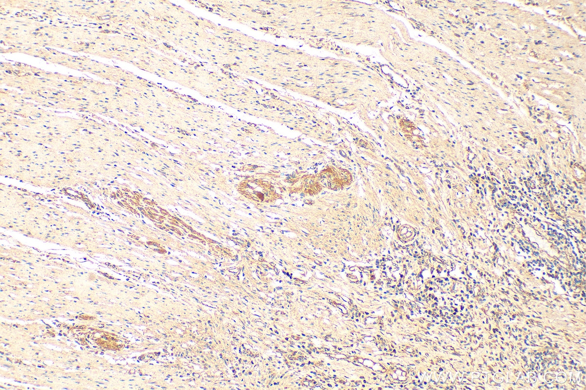 Immunohistochemistry (IHC) staining of human colon cancer tissue using MTHFD2 Polyclonal antibody (12270-1-AP)