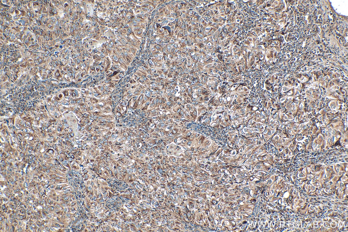 Immunohistochemistry (IHC) staining of human lung cancer tissue using MTHFD2 Monoclonal antibody (68524-1-Ig)