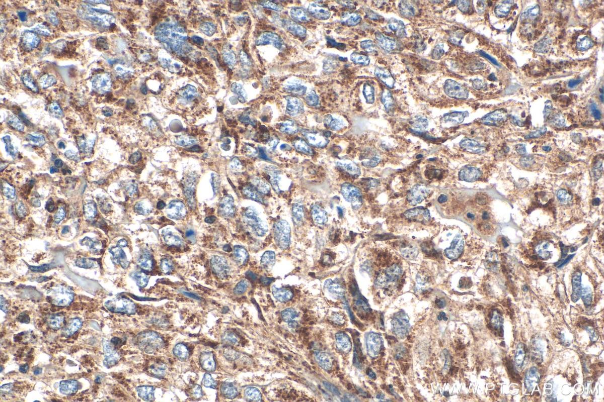 Immunohistochemistry (IHC) staining of human lung cancer tissue using MTHFD2 Monoclonal antibody (68524-1-Ig)
