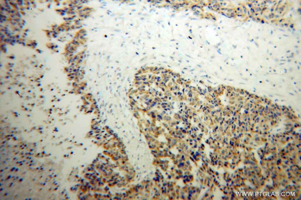 Immunohistochemistry (IHC) staining of human liver cancer tissue using MTHFS Polyclonal antibody (13114-1-AP)