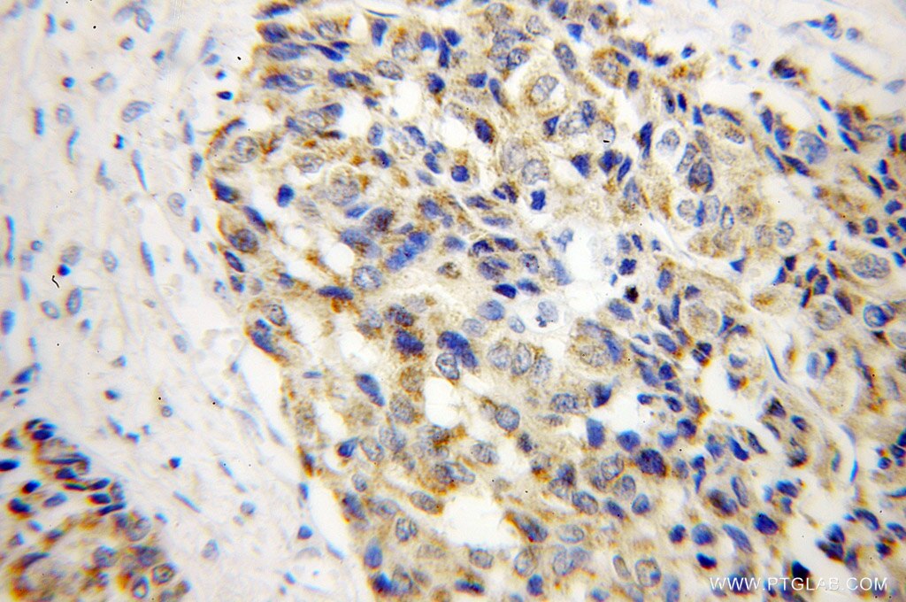 Immunohistochemistry (IHC) staining of human liver cancer tissue using MTHFS Polyclonal antibody (13114-1-AP)