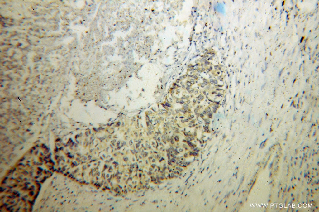 Immunohistochemistry (IHC) staining of human liver cancer tissue using MTHFS Polyclonal antibody (13114-1-AP)