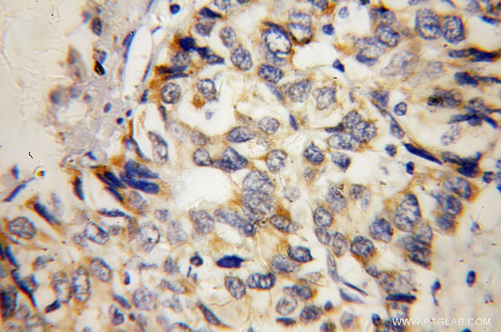 Immunohistochemistry (IHC) staining of human liver cancer tissue using MTHFS Polyclonal antibody (13114-1-AP)