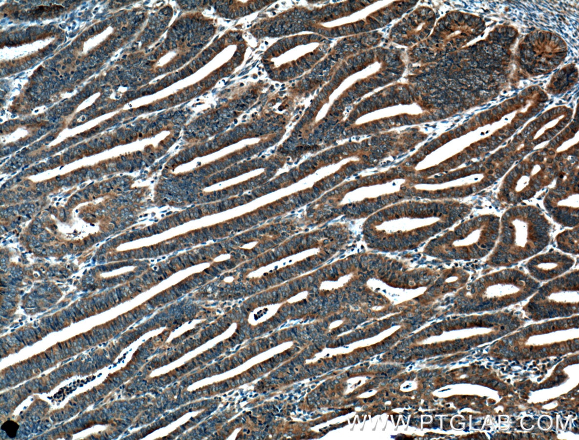 Immunohistochemistry (IHC) staining of human endometrial cancer tissue using MTMR2 Polyclonal antibody (14372-1-AP)