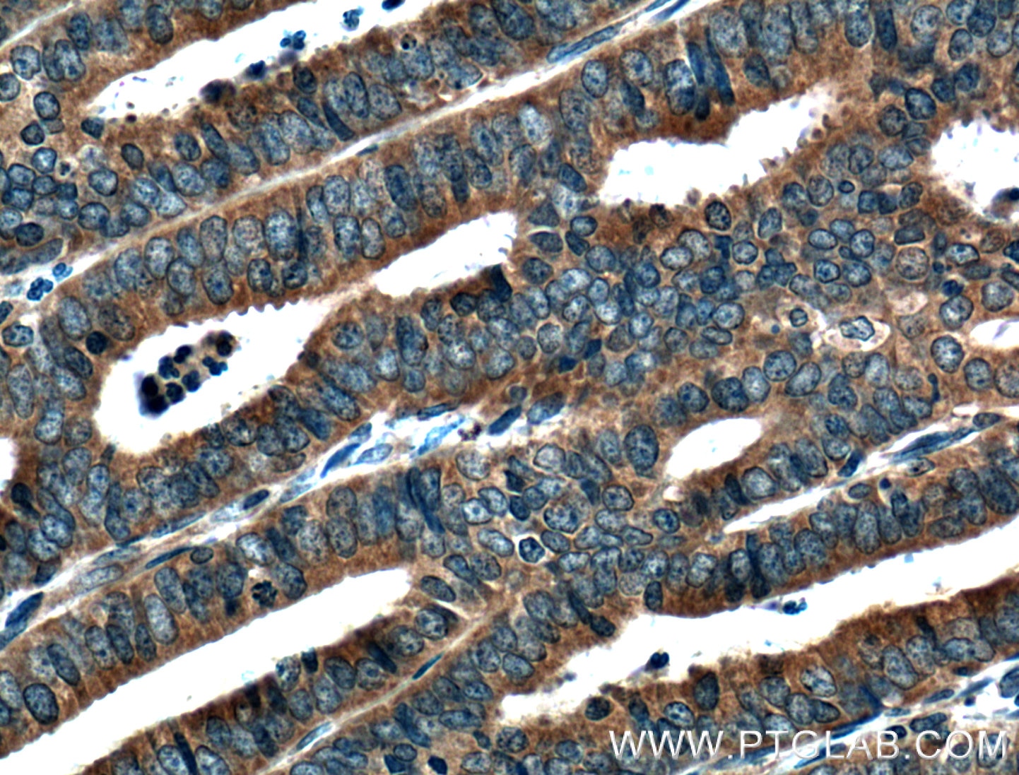 Immunohistochemistry (IHC) staining of human endometrial cancer tissue using MTMR2 Polyclonal antibody (14372-1-AP)