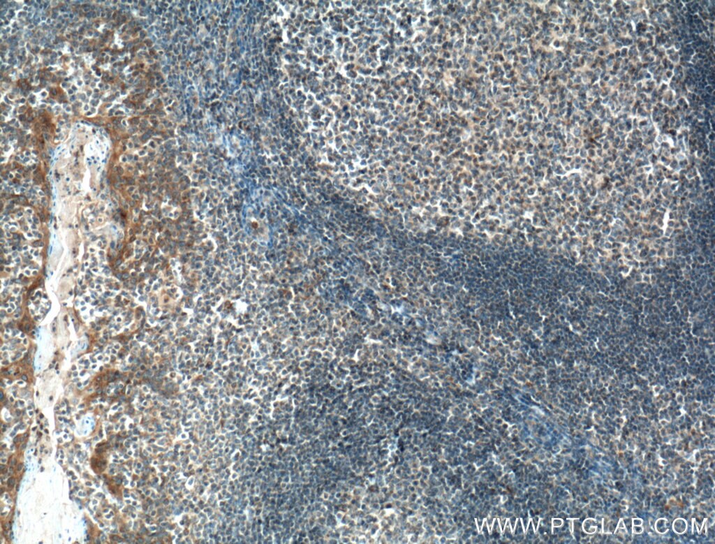 IHC staining of human tonsillitis using 21336-1-AP