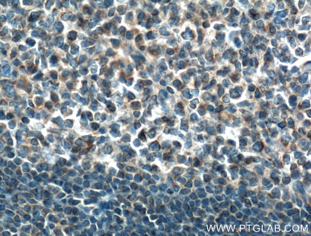 Immunohistochemistry (IHC) staining of human tonsillitis tissue using MTMR3 Polyclonal antibody (21336-1-AP)