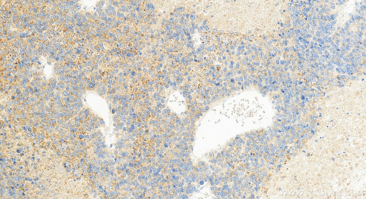Immunohistochemistry (IHC) staining of Hepatocellular carcinoma tissue using MTMR4 Polyclonal antibody (13488-1-AP)