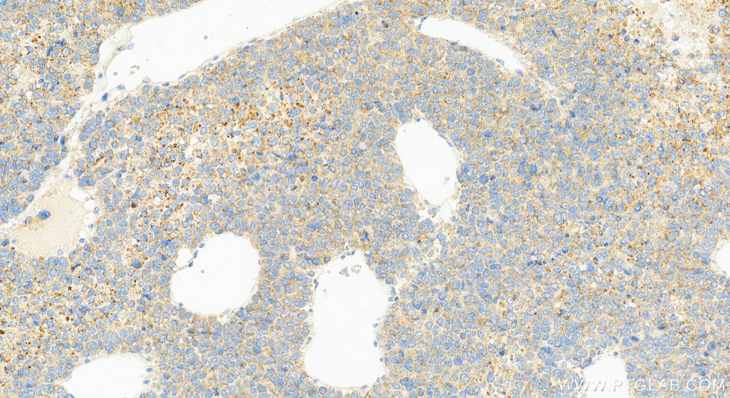 Immunohistochemistry (IHC) staining of Hepatocellular carcinoma tissue using MTMR4 Polyclonal antibody (13488-1-AP)