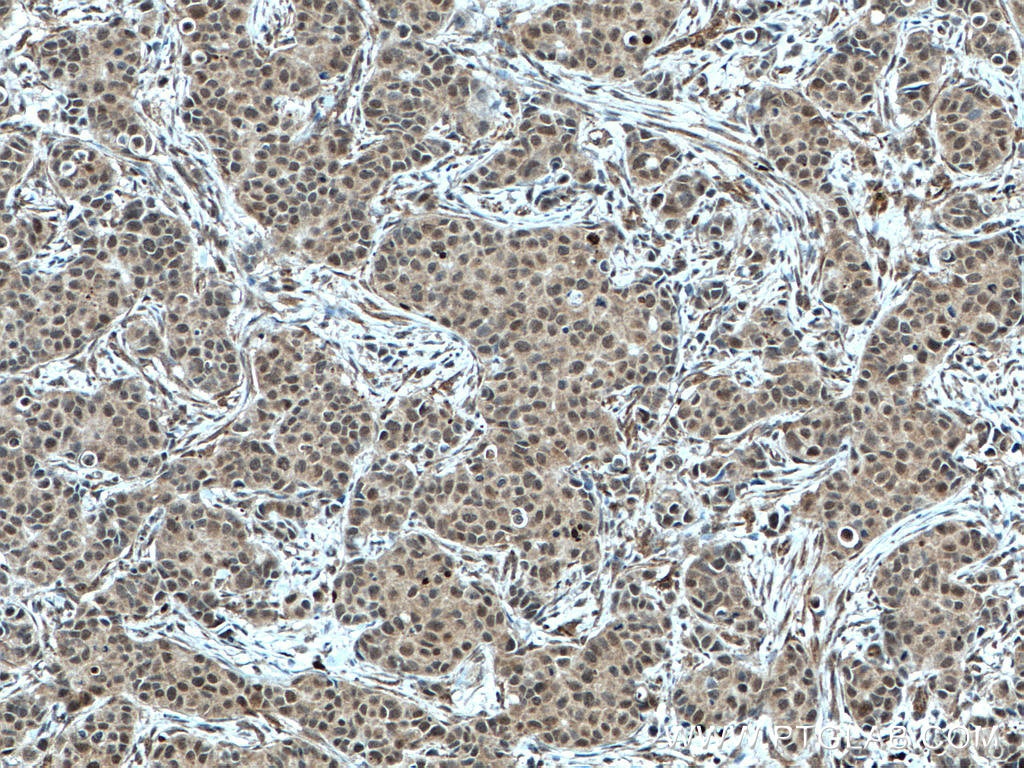 Immunohistochemistry (IHC) staining of human breast cancer tissue using mTOR Polyclonal antibody (20657-1-AP)